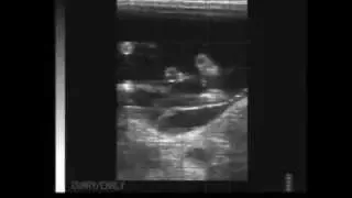 Echographie de la mamelle